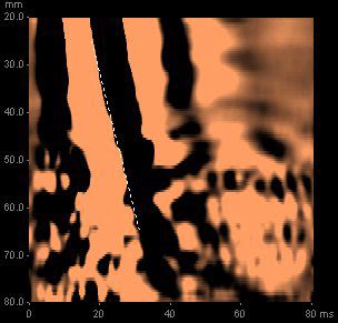 bad fibroscan results|RACGP .